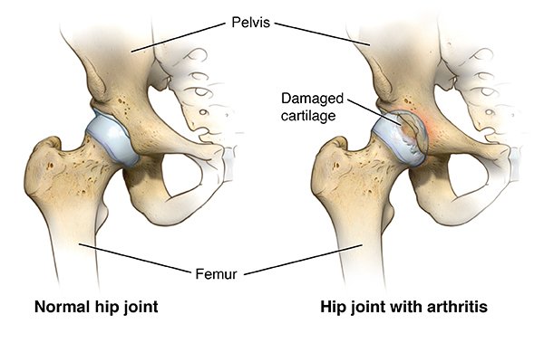 Hip surgery